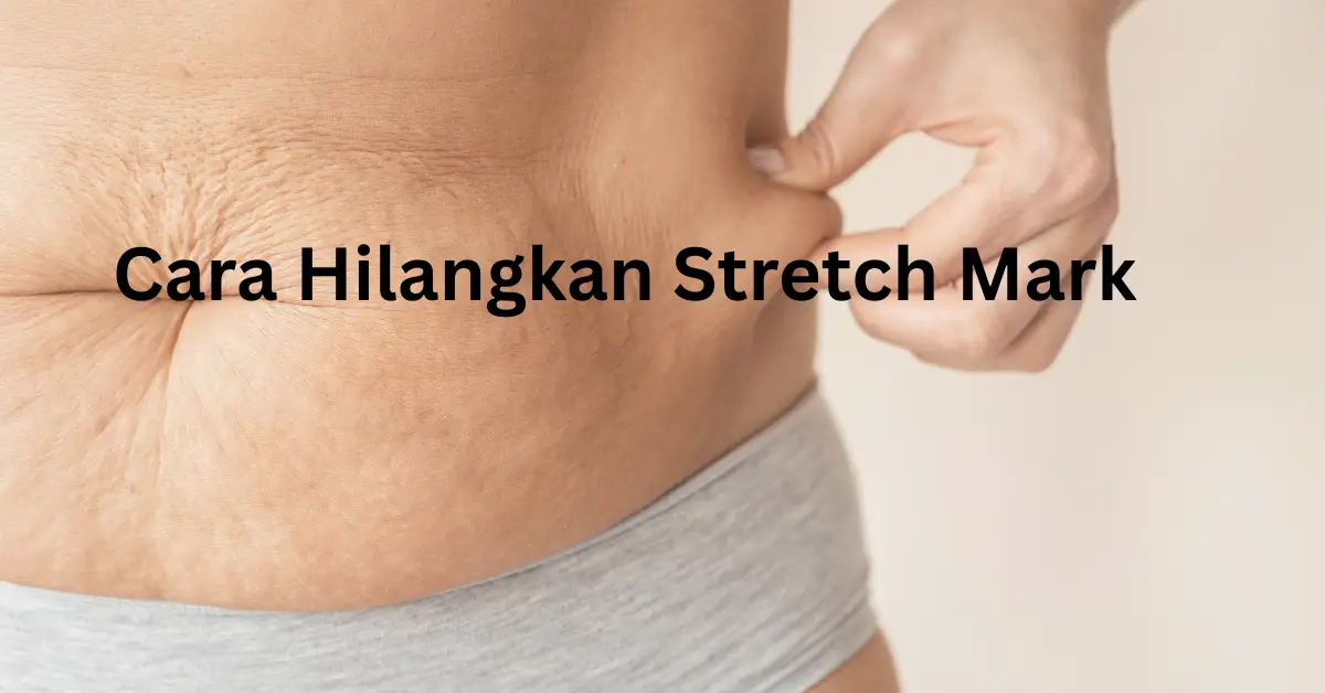 cara hilangkan stretch mark